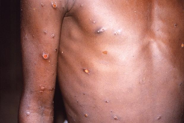 Figures suggest the number of Monkeypox cases in the UK is starting to plateau (PA)
