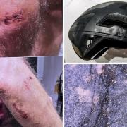 Andy Watts's injuries, his damaged bike and holes in the road