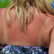 A woman with sunburn. Image: Anthony Devlin/PA Wire.