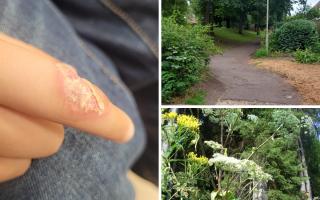 Warning from mother after son is burned by deadly giant hogweed plant