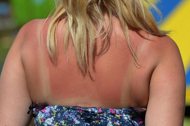 A woman with sunburn. Image: Anthony Devlin/PA Wire.